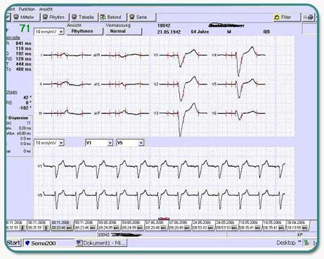 Ruhe-EKG mit Linksschenkelblock, einer Leitungsstörung